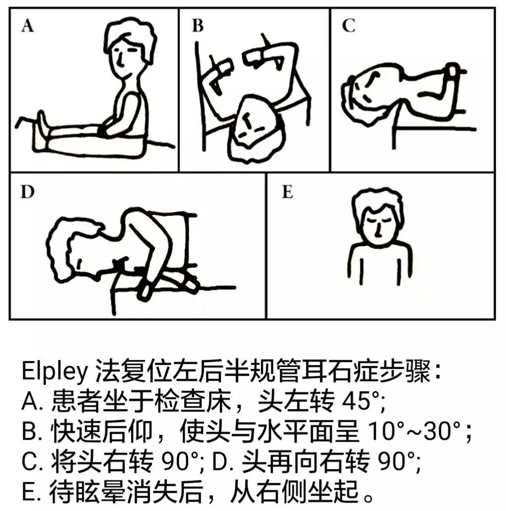 约翰•艾普利：眩晕之“耳石症”治疗的前世今生