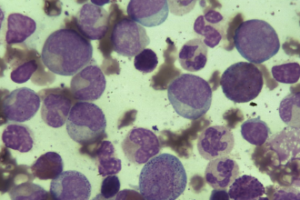 慢性粒细胞<em>白血病</em>的镜下表现